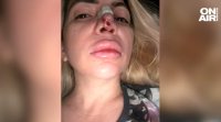 Жена твърди че е обезобразена след ринопластика След 2 операции