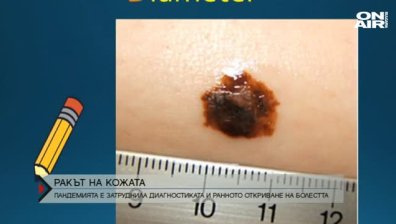 Пандемията е затруднила ранната диагностика на рака на кожата