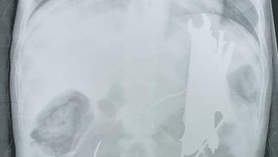 Лекари извадиха гаечен ключ, отвертка, пирони и болтове от тялото мъж (Снимки)