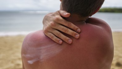 Дерматолог: Няма здравословен тен, слънцезащитата трябва да е целогодишна