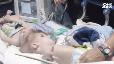 Разделиха успешно сиамски близнаци