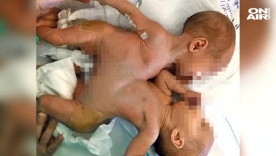 Уникална операция: Хърватски лекари успяха да разделят сиамски близначки