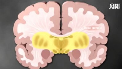 Безплатни консултации за пациенти с Паркинсон у нас