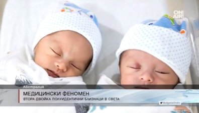 Вторите в света полуидентични близнаци се родиха в Австралия
