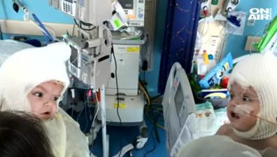 Разделиха и изписаха сиамски близнаци за Коледа