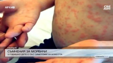 2-годишно дете в Пловдив е със симптоми за морбили