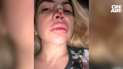 Жена твърди, че е обезобразена след ринопластика: Уча се наново да дишам