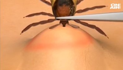 Инфекционист: Не въртете и не мажете с мазнина кърлежите