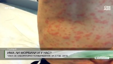 Центърът по заразни болести казва дали у нас има морбили
