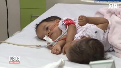 От Хималаите до Мелбърн: Разделиха успешно сиамски близначки