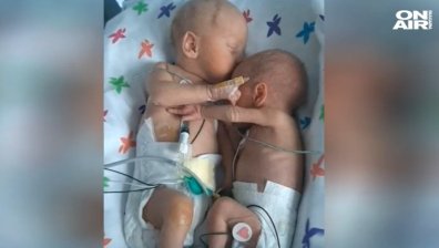 Снимка на сиамски близнаци, които се прегръщат след операция, трогна света