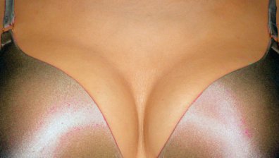 30 000 французойки жертва на фалшив силикон