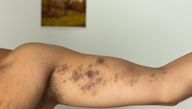 Момче твърди, че е пребито от охраната на дискотека в Пловдив