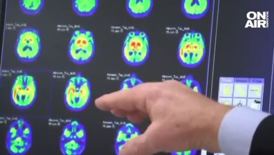 Новооткритото лекарство срещу Алцхаймер може да има тежки странични ефекти?