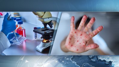 Изследват още 18 нови проби на хора със съмнение за морбили