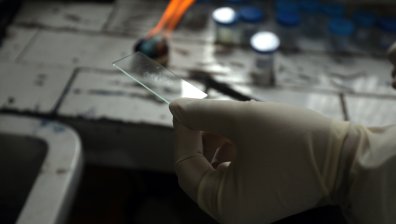 Ден за борба с туберкулозата, случаите у нас са все по-малко