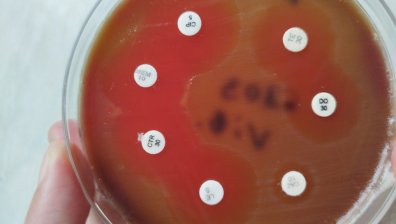 Лекари от Бургас спасиха жена от смъртоносна "бактерия човекоядец"