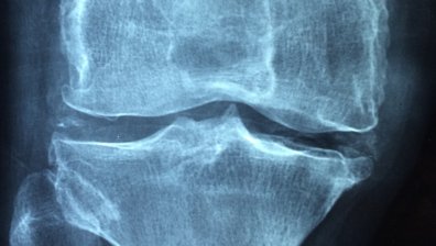 Учени откриха връзка между мръсния въздух и остеопорозата