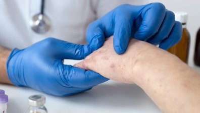 Общо 132 случая на морбили у нас - най-голямото огнище е във Враца