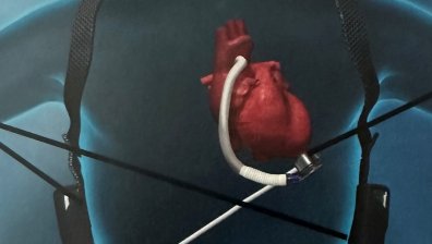 Поставиха нова генерация изкуствено сърце на мъж в УМБАЛ "Проф. д-р А. Чирков"