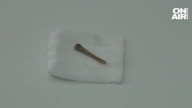 Мъж със заседнала кост в дихателните пътища е лекуван 4 месеца за бронхопневмония