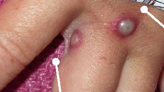 За България са предвидени до 1820 дози от ваксината на