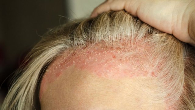 Псориазисът е възпалително кожно заболяване което може да засегне всички