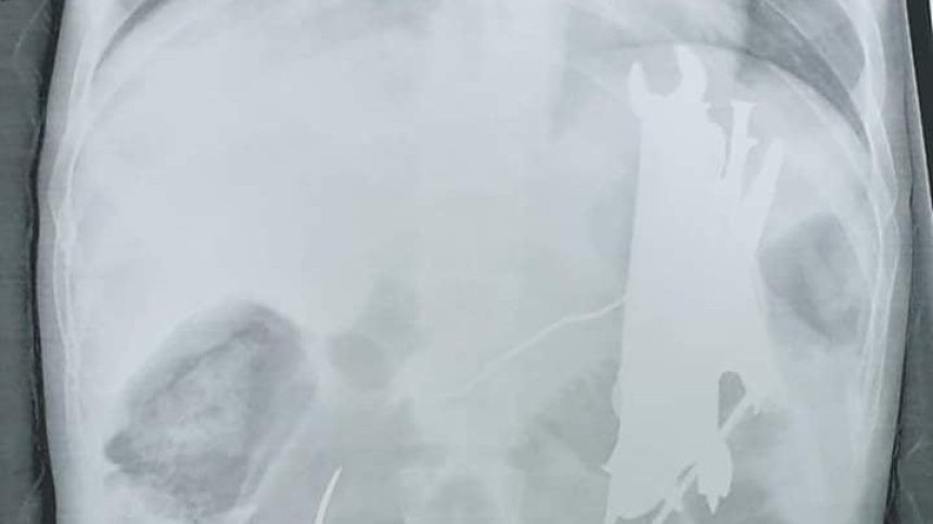 Лекари извадиха гаечен ключ, отвертка, пирони и болтове от тялото мъж (Снимки)