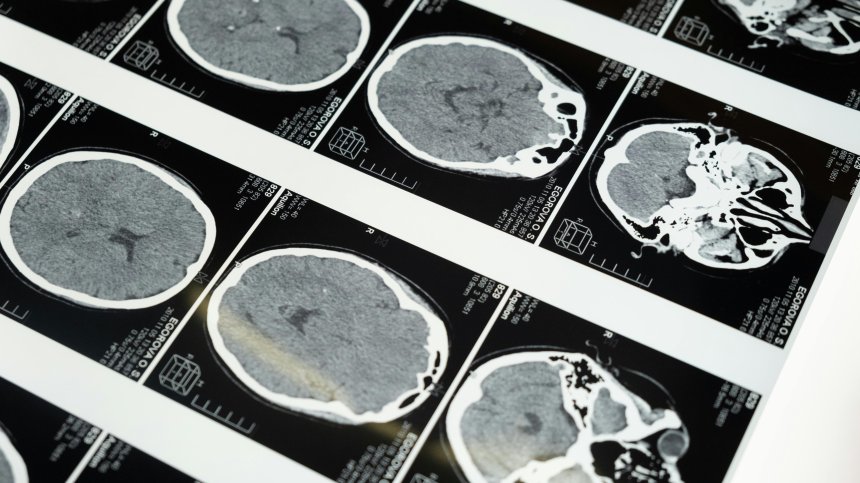  Neuralink на Мъск призна за проблеми с имплантирано в човек устройство