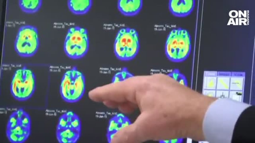 Новооткритото лекарство срещу Алцхаймер може да има тежки странични ефекти?