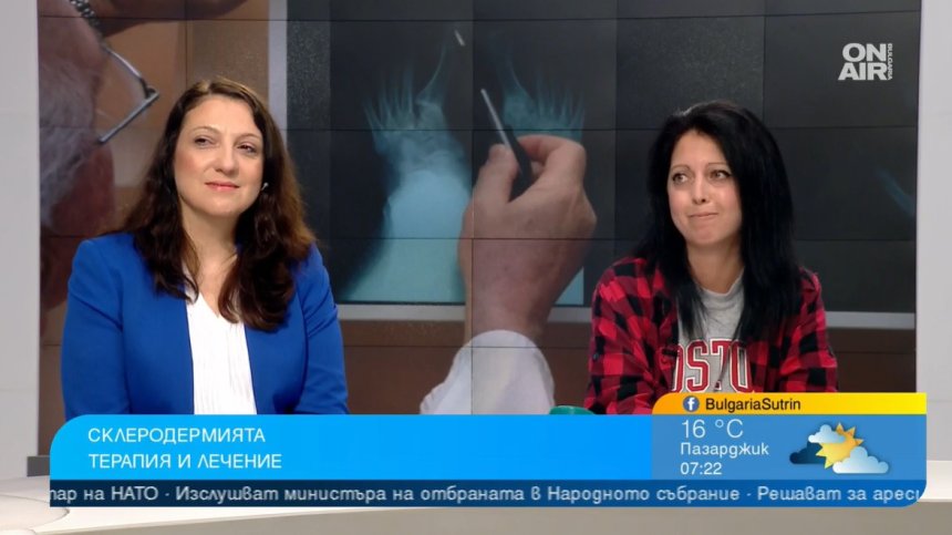 Късна диагноза: "Лекуваха ме от студова алергия, оказа се склеродермия, не можех да обеля картоф"