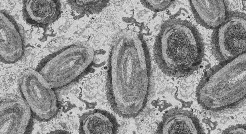Мъж е заразен от лек вариант на маймунска шарка в Словения