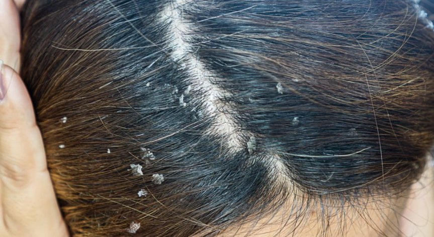 Как да излекуваме себорейния дерматит?