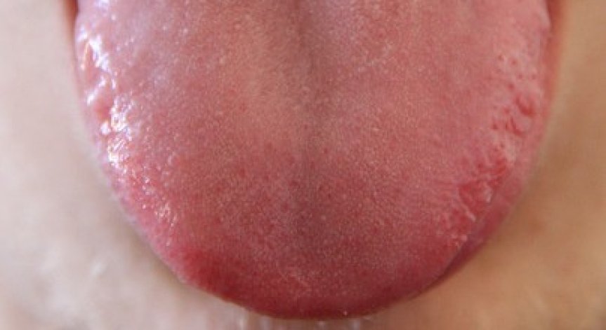 Не пренебрегвайте болките в езика, карциномът е най-честият вид рак на лигавицата