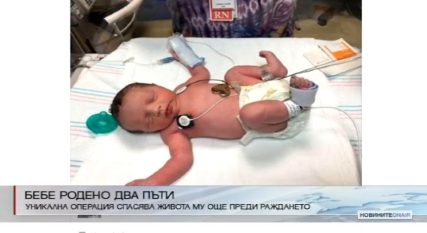 Бебе се роди два пъти след уникална операция