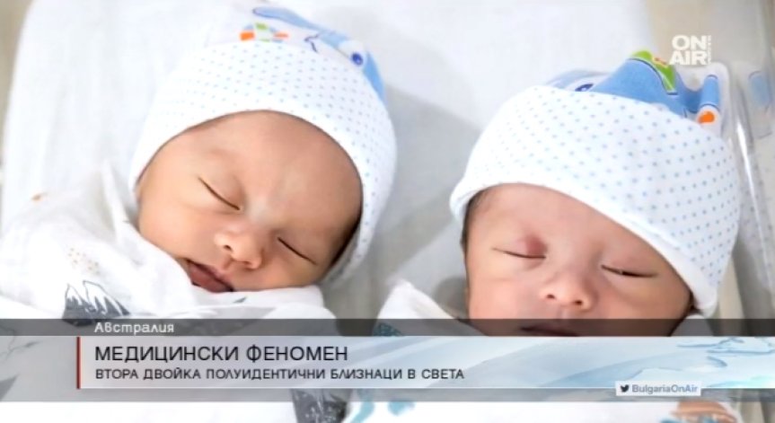 Вторите в света полуидентични близнаци се родиха в Австралия
