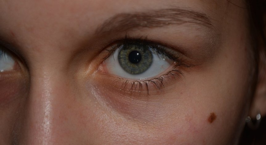 Меланомът на кожата мъчи около 630 българи годишно