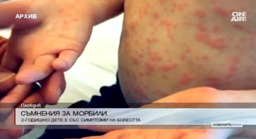 2-годишно дете в Пловдив е със симптоми за морбили