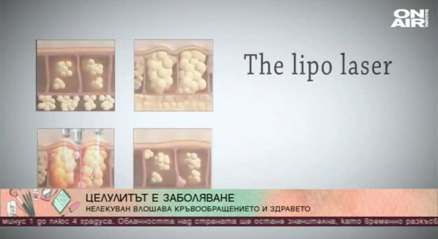 90% от жените са засегнати от целулита
