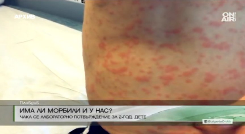 Центърът по заразни болести казва дали у нас има морбили