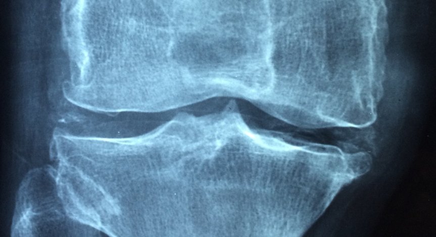 Учени откриха връзка между мръсния въздух и остеопорозата