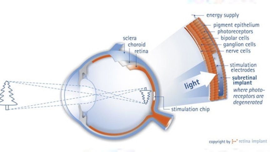 Графика на Retina Implant показва как функционира чипът (в синьо)